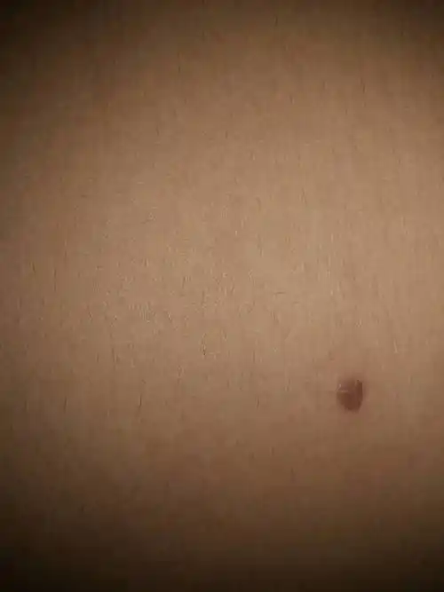 前几天身上莫名其妙的多了一个黑点,我想问问这个是皮肤癌的征兆吗?