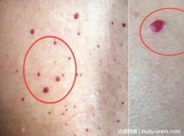 红痣与朱砂痣区别图片(红痣与朱砂痣是什么意思)