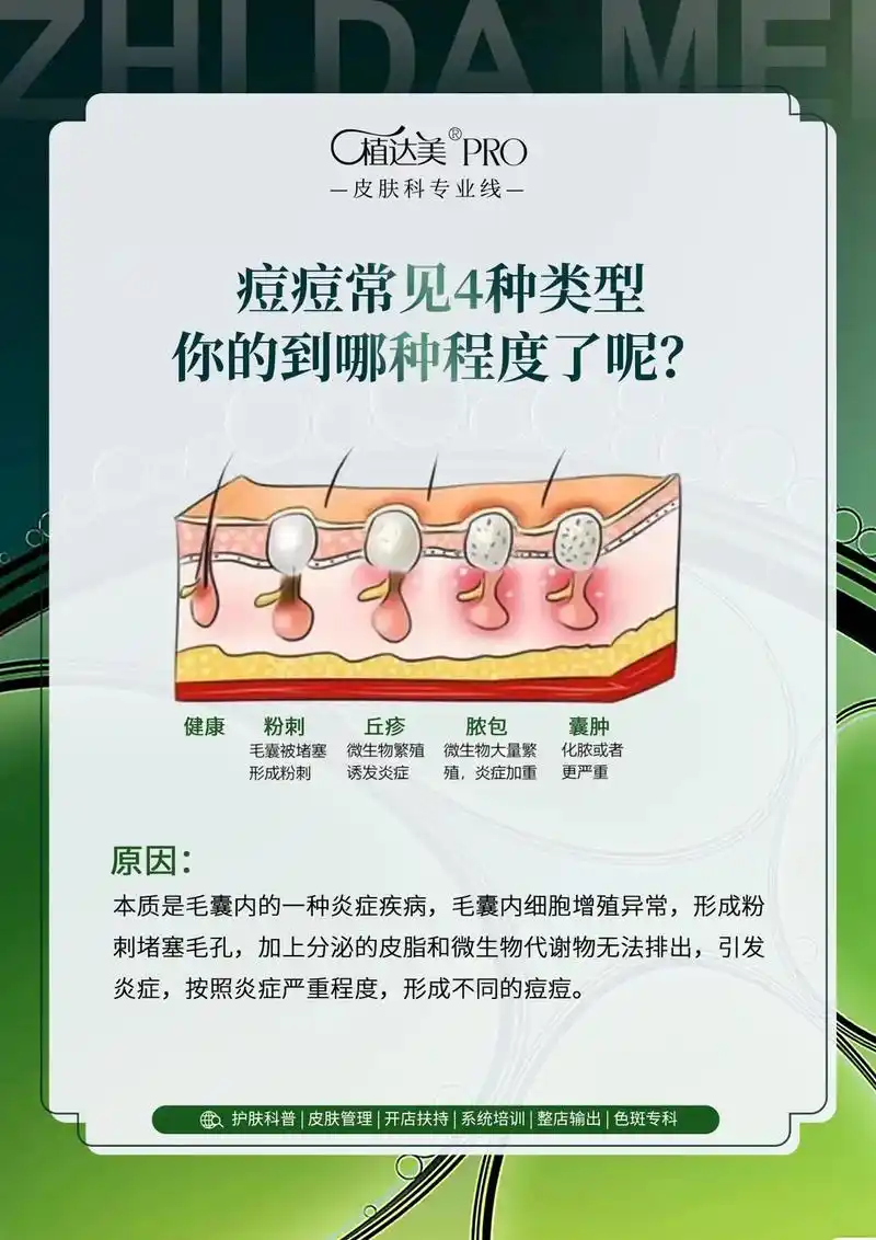 常见痘痘4中类型,对症看看.痘痘也叫痤疮,也称粉刺,是一种毛 - 抖音