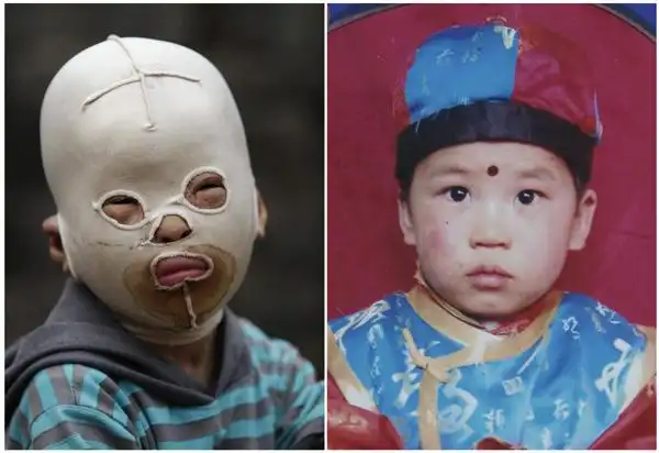 masked boy barred from kindergarten due to burns