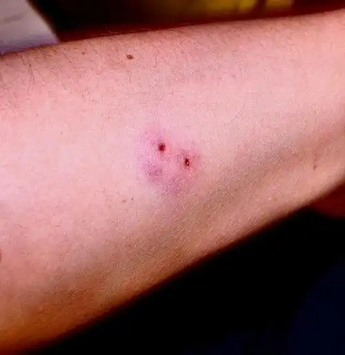 一女子被毒蛇咬伤  蛇吧被毒蛇咬伤图片