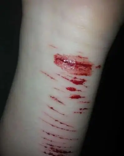 自残的方式找到自我存在的感觉,你病了,要找专业的咨询师,治疗一下