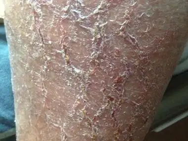 皲裂性湿疹小腿皮肤干燥脱屑裂口图