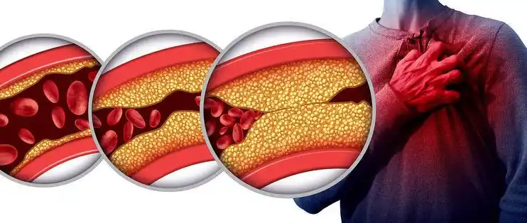 颈动脉斑块给老年父母买保险不再头疼