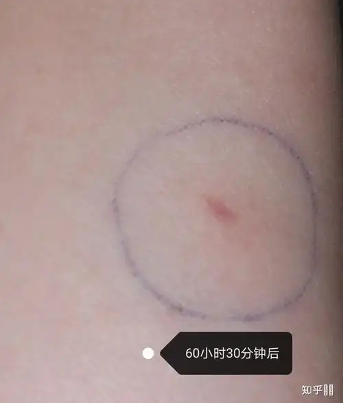 结核皮试出现如下状况,是啥结果呢?