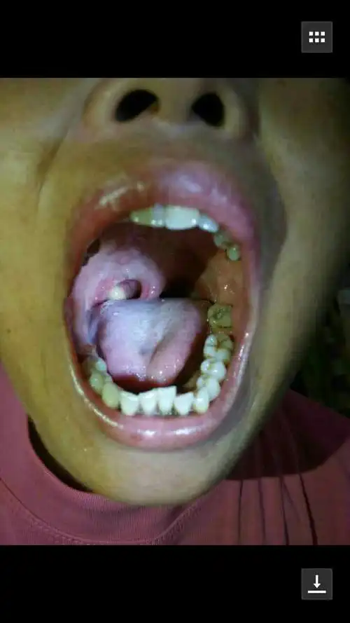 喉咙那里起白泡泡,怎么回事?医生说还要开刀呢.