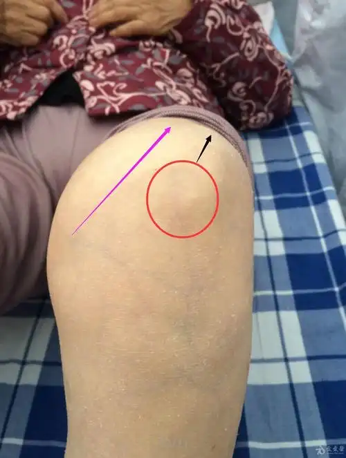 骨性膝关节炎的治疗思路