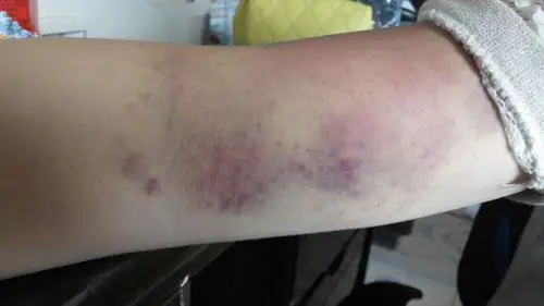 传说拍手臂可排毒?