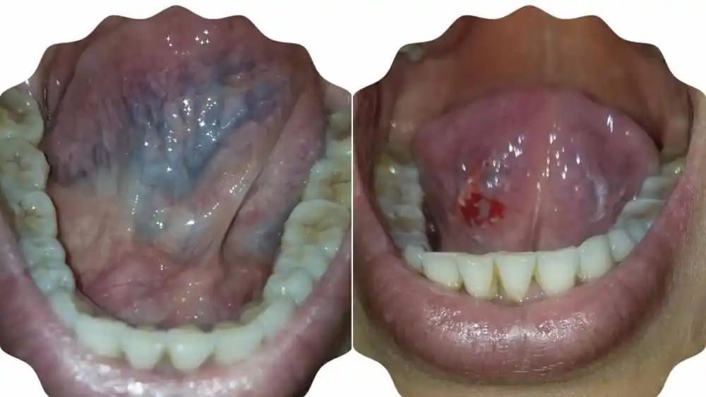 关于舌下取栓,方法不同,效果更好