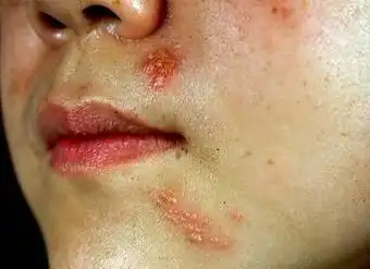 徐州哪家医院治疗疱疹好 徐州京城皮肤病医院专家介绍说,很多带状疱疹