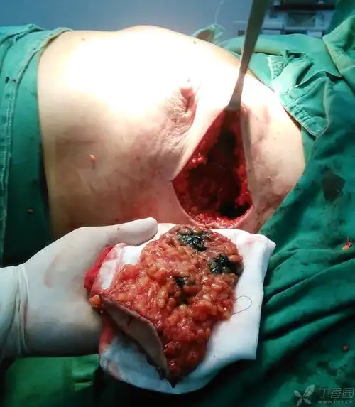 胸外侧皮瓣在乳腺癌肿瘤整形保乳中的应用 [病例帖]