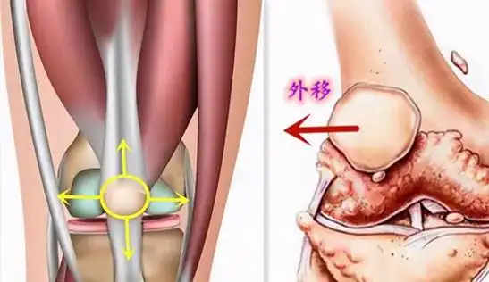 常见的一种不平衡为例,就是大多数人的软骨退变是因为膝盖骨外移所致