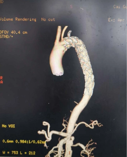 拆弹专家再出新招castor分支支架治疗胸主动脉夹层