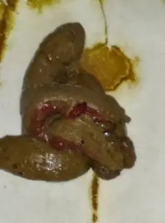 大便带血是怎么回事ltbr