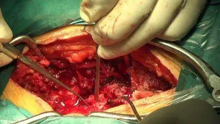 椎管狭窄手术费用_成都骨科医院-成都颈腰椎病医院-成都中山高新骨科