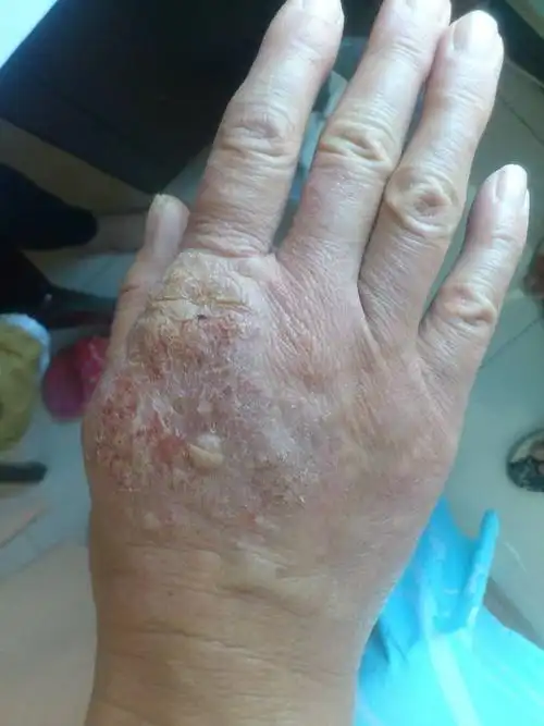 你好问下手背上开始有点痒然后抓着后