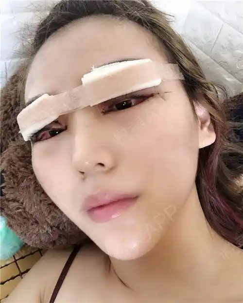 全切双眼皮手术当天_眼综合手术当天_开眼角手术当天_双眼皮手术当天