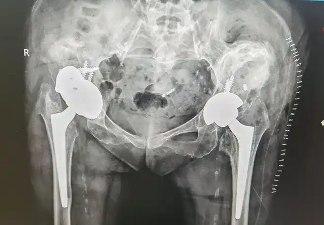 关节假体脱位致女子忍痛20年翻修双髋再次自由行走