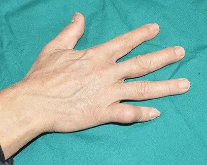 伸肌腱中央腱束损伤(钮扣畸形)侧腱束交叉缝合法