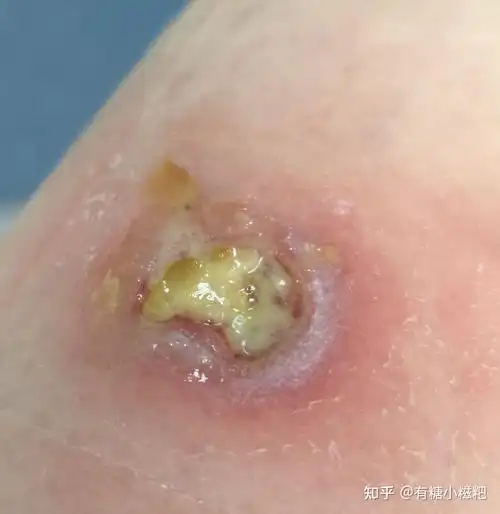 低温烫伤治疗全程记录,持续更新,多图慎入! - 知乎