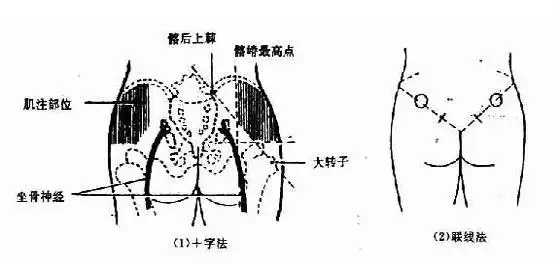 划一水平线,从服务员骼嵴最高点作一垂直平分线,将臀部分为4个象限,其