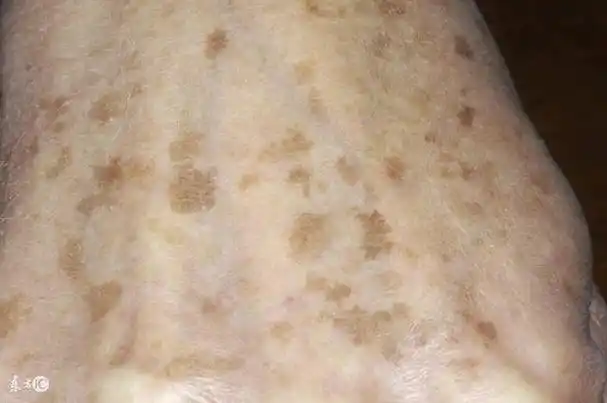 脂溢性角化年轻人为什么长