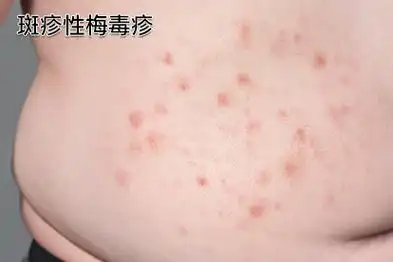 梅毒疹图片