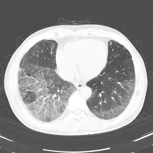 脱屑性间质性肺炎dip