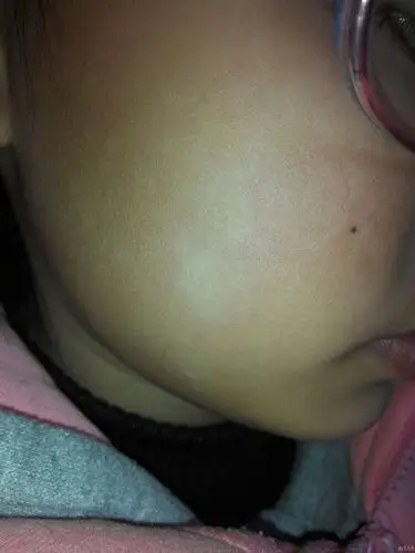 临床第三区 69 皮肤及性传播疾病讨论版 69 小女孩脸上这白斑是