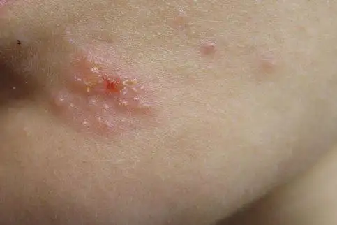 疱疹与过敏性皮炎图片比较