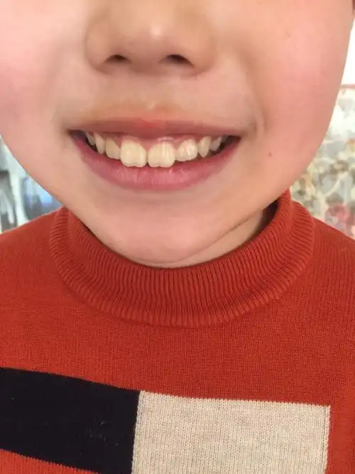 黄医生你好我的孩子10岁上牙感觉有点凸笑起来露牙龈多