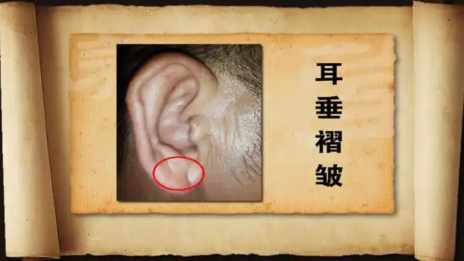 心梗,冠心病,心气虚,心阳不足,血运山根横纹,不畅,冠状沟,气虚血瘀