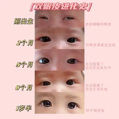 双眼皮虽迟但到耐心等等总会有的