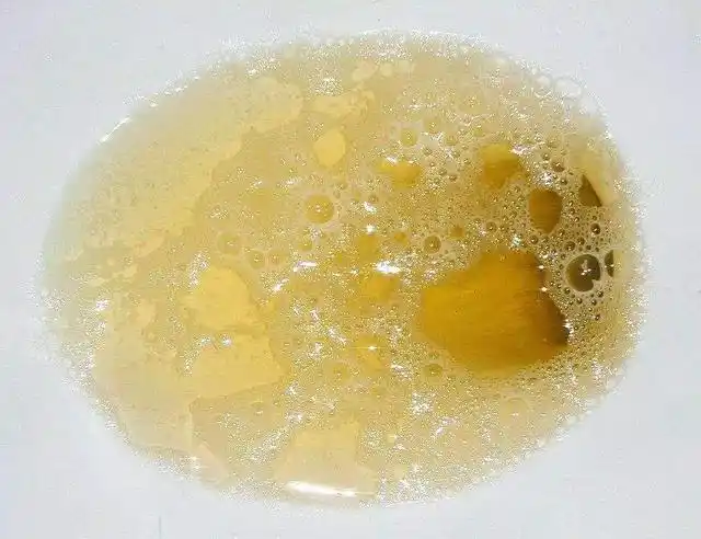 如果糖尿病患者晨起发现小便出现明显的泡沫,而且经久不散,并且尿液