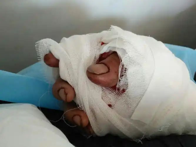 回病房后再植手指(拇指,示指)血运良好.