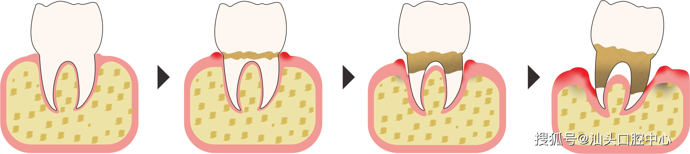 得了牙周炎,不去治疗可以自愈吗?_牙齿_牙龈_炎症