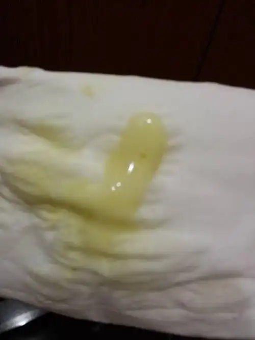 上个月检查出轻度宫颈糜烂,医生开了十二天的栓药,这个月白带这样了