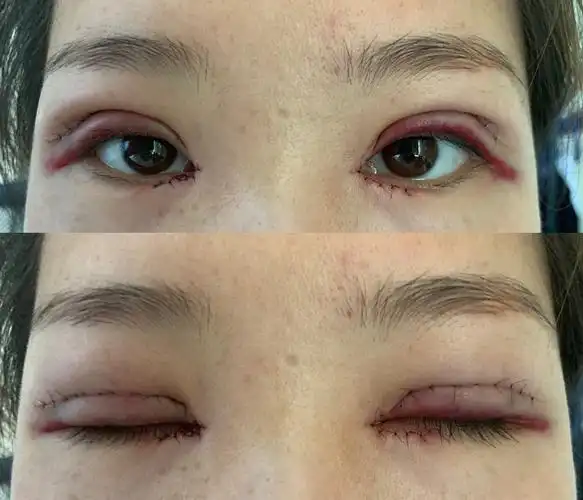 眼综合术后全过程分享