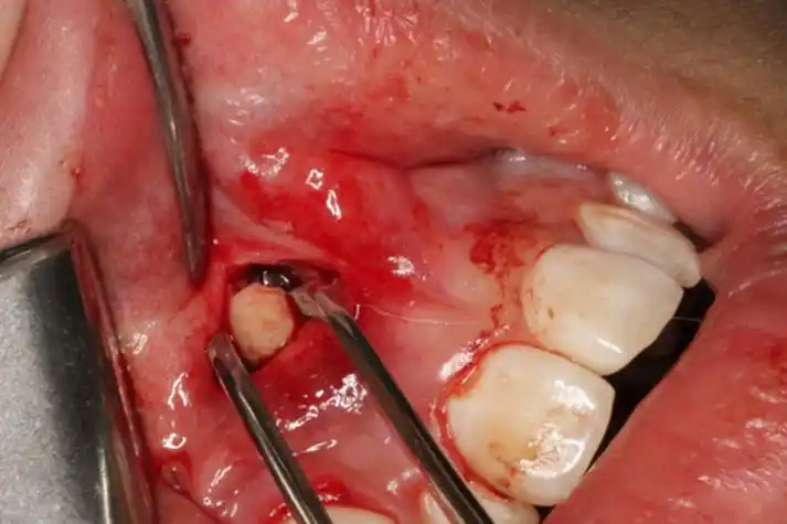 恒牙从牙龈外侧长出来图片_有来医生