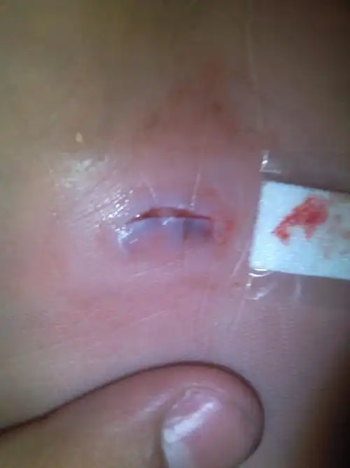 化脓了.看看我的脚需不需要我把外面那成感染的