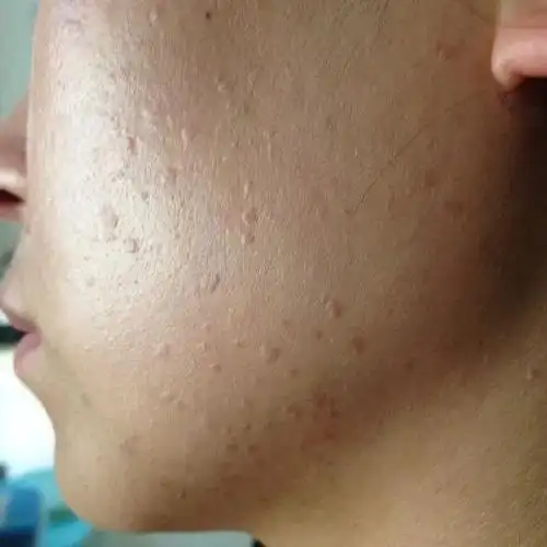 这个疙瘩是扁平疣可别当成青春痘给挤了