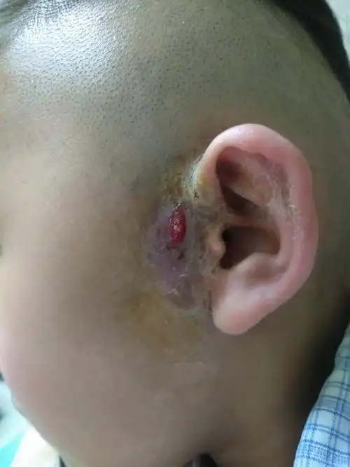 最近"仓眼"很多,需要手术切除!