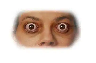 金鱼眼的人命运怎么样?金鱼眼我们俗称大泡眼-风水八字同城网