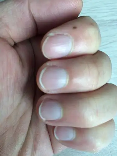 指甲发白是何种疾病?