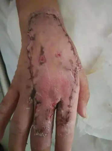 术后植皮区皮肤成活良好.