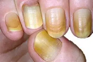 指甲发生的这4个变化,是肝脏的"求救信号",小心拖成肝癌!