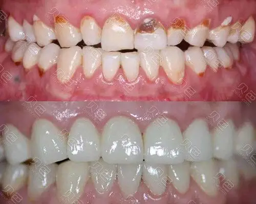 牙齿修复前后对比照片