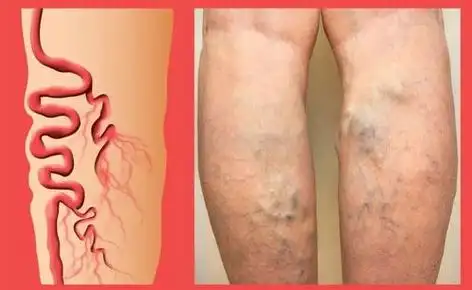 精索静脉曲张是指精索蔓状静脉丛扩张,伸长,迁曲而形成的阴囊血管性