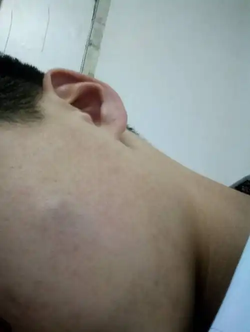 脸上长了一个痘硬硬的不痛,很久了,以前只是摸着有,现在大了,怎么解决