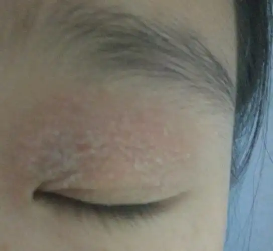眼睛红肿发干脱皮发痒 要怎么治 ?